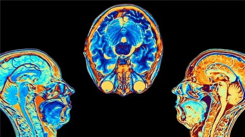 Imagen de la noticia: Covid: el estudio que muestra cómo cambia el cerebro tras una infección por coronavirus, aunque esta sea leve