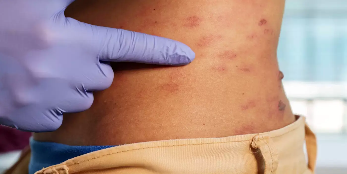Imagen de la noticia: Aumento de casos de Herpes Zóster en Guayaquil por falta de ventilación y cortes de energía