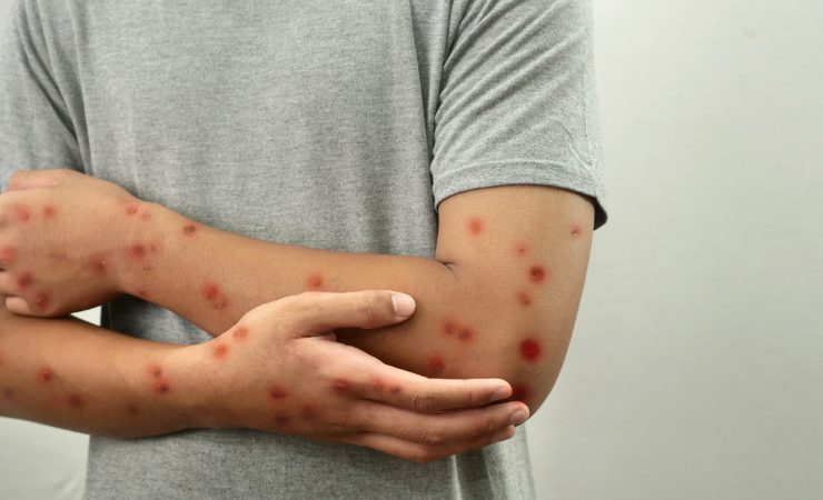 Imagen de la noticia: Más de 26.000 casos de viruela del mono en 2025, según alerta de la OMS