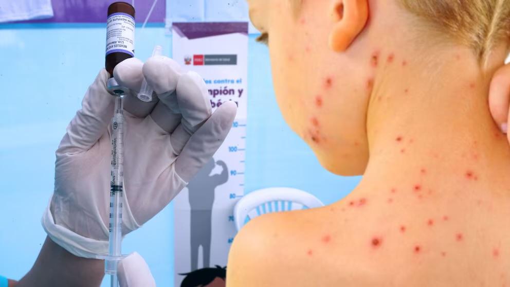 Perú declara emergencia sanitaria por brote de sarampión