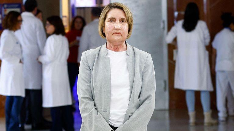 Realizan el primer trasplante de cara del mundo con una donante que recibió la eutanasia